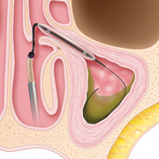 Image of: A balloon is inserted into the sinus over the guide wire and inflated to remodel and expand the sinus passageway.