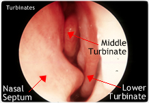 inflamed nasal turbinates